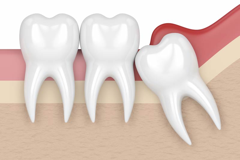 Wisdom Tooth Removal in Elsa